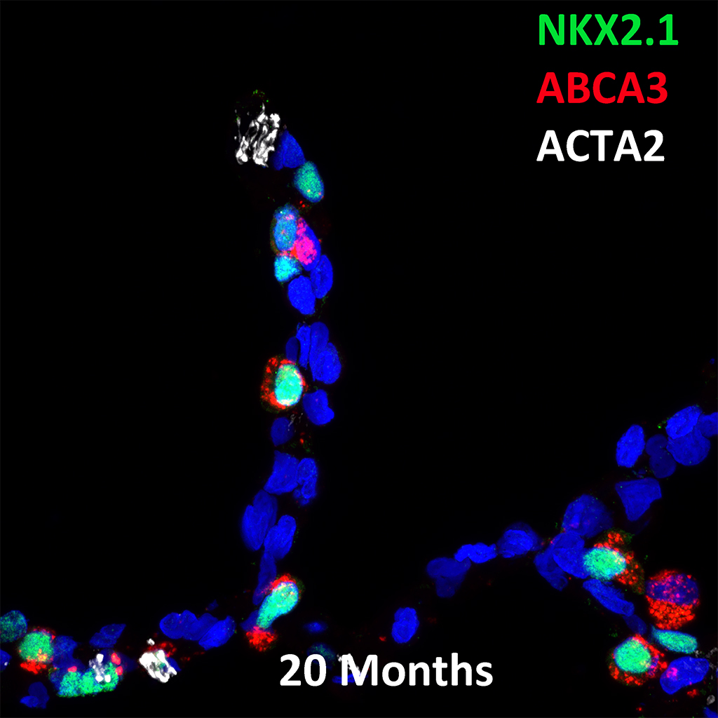 20 Month Human NKX2.1, ABCA3, and ACTA2 Confocal Imaging