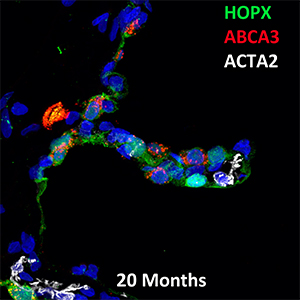 20 Month Human HOPX, ABCA3, and ACTA2 Confocal Imaging