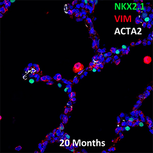 20 Month Human NKX2.1, VIM, and ACTA2 Confocal Imaging