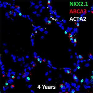 4 Year Old Human Lung NKX2.1, ABCA3, and ACTA2 Confocal Imaging
