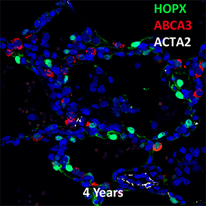4 Year Old Human Lung HOPX, ABCA3, and ACTA2 Confocal Imaging