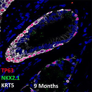 9 Month Old Human Lung TP63, NKX2.1, and KRT5 Confocal Imaging