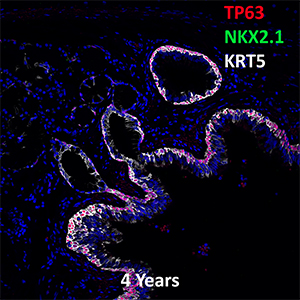 4 Year Old Human Lung TP63, NKX2.1, and KRT5 Confocal Imaging