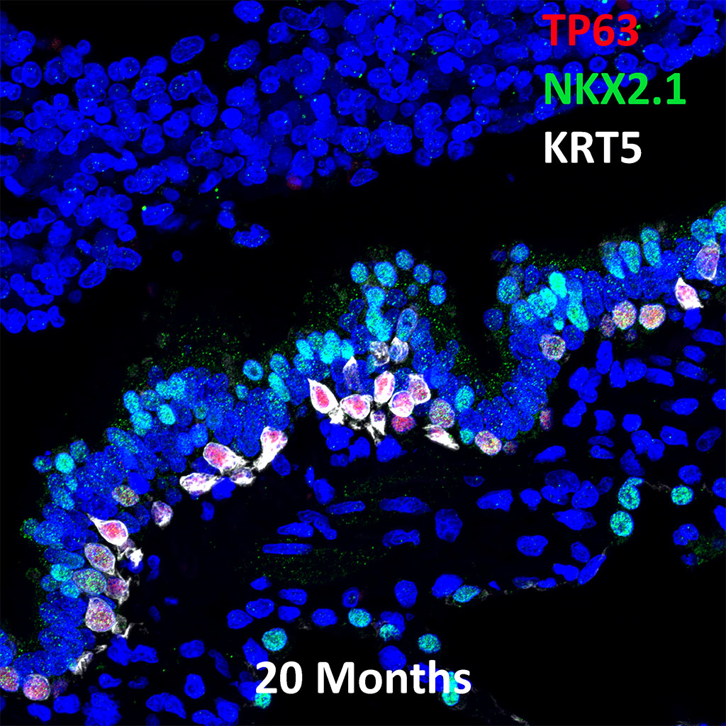 20 Month Old Human Lung TP63, NKX2.1, and KRT5 Confocal Imaging