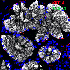4 Year Old Human Lung KRT14, NKX2.1, and MUC5B Confocal Imaging