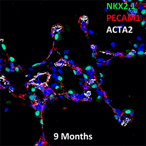 9 Month Old Human Lung NKX2.1, PECAM, and ACTA2 Confocal Imaging