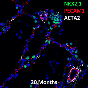 20 Month Old Human Lung NKX2.1, PECAM-1, and ACTA2 Confocal Imaging
