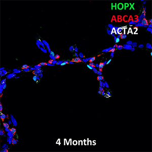 4 Month Human Lung HOPX, ABCA3, and ACTA2 Confocal Imaging