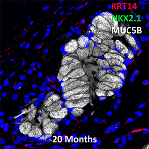 20 Month Old Human Lung KRT14, NKX2.1, and MUC5B Confocal Imaging