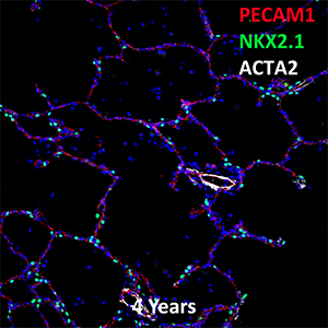 4 Year Old Human Lung PECAM-1, NKX2.1, and ACTA2 Confocal Imaging