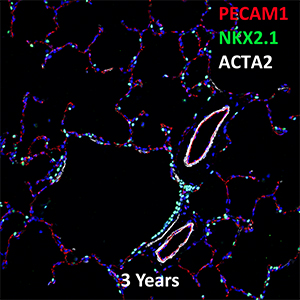 3 Year Old Human Lung PECAM-1, NKX2.1, and ACTA2 Confocal Imaging