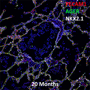 20 Month Human Lung PECAM-1, AGER, and NKX2.1 Confocal Imaging