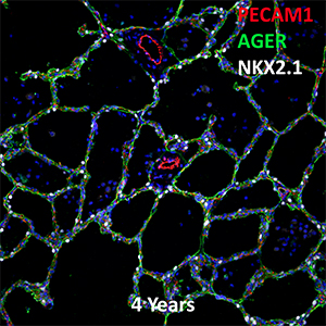 4 Year Human Lung PECAM-1, AGER, and NKX2.1 Confocal Imaging