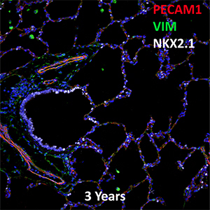 3 Year Human Lung PECAM-1, VIM, and NKX2.1 Confocal Imaging