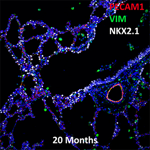 20 Month Human Lung PECAM-1, VIM, and NKX2.1 Confocal Imaging
