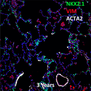 3 Year Old Human Lung NKX2.1, VIM, and ACTA2 Confocal Imaging