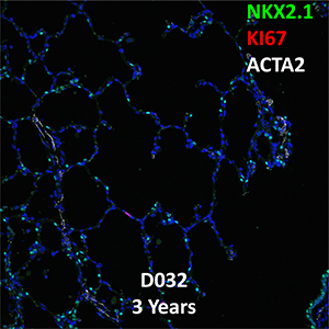 3 Year-Old Human Lung NKX2.1, KI67, and ACTA2 Confocal Imaging