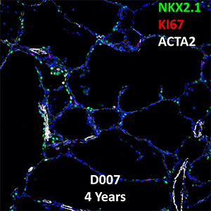 4 Year-Old Human Lung NKX2.1, KI67, and ACTA2 Confocal Imaging