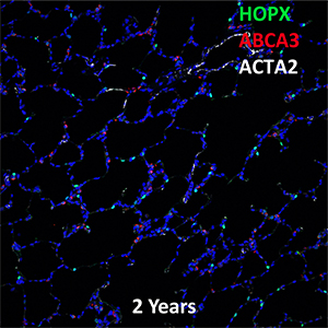 2 Year Human Lung HOPX, ABCA3, and ACTA2 Confocal Imaging