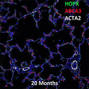 20 Month Human HOPX, ABCA3, and ACTA2 Confocal Imaging