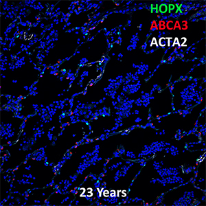 23 Year Old Human Lung HOPX, ABCA3, and ACTA2 Confocal Imaging