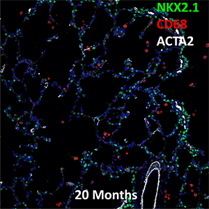 20 Month Human Lung NKX2.1, CD68, and ACTA2 Confocal Imaging