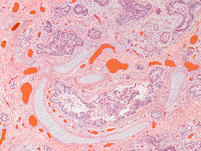H&E Staining of Human Lung Containing TBX4 Deletion