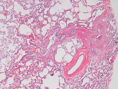 H&E Staining of a 6 Month-Old Human Lung Containing TBX4 Deletion