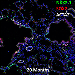 20 Month-Old Human Lung NKX2.1, SOX2, and ACTA2 Confocal Imaging