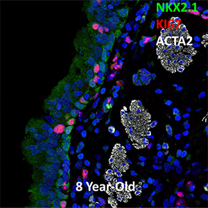 8 Year-Old Human Lung NKX2.1, KI67, and ACTA2 Confocal Imaging