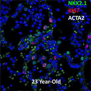 23 Year Human Lung NKX2.1, KI67, and ACTA2 Confocal Imaging