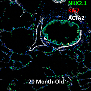 20 Month-Old Human Lung NKX2.1, KI67, and ACTA2 Confocal Imaging