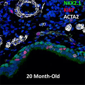 20 Month-Old Human Lung NKX2.1, KI67, and ACTA2 Confocal Imaging