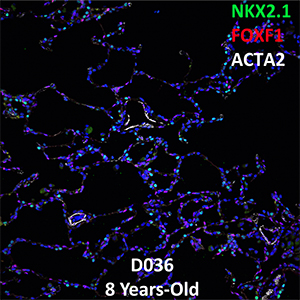 20 Month Old Human Lung LMH-16-D036 NKX2.1, FOXF1, and ACTA2