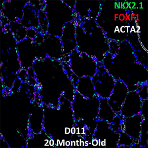 20 Month Old Human Lung LMH-16-D011 NKX2.1, FOXF1, and ACTA2