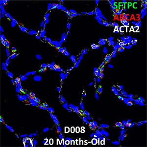 20 Month-Old Human Lung Confocal Imaging Donor D008 SFTPC, ABCA3, and ACTA2