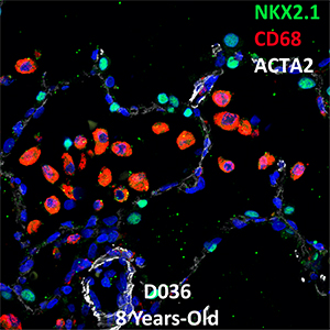 8 Year-Old Human Lung Confocal Imaging NKX2.1, CD68, and ACTA2