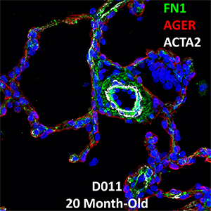 20 Month-Old Human Lung Confocal Imaging Donor D011 FN1, AGER, and ACTA2