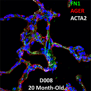 20 Month-Old Human Lung Confocal Imaging Donor D008 FN1, AGER, and ACTA2