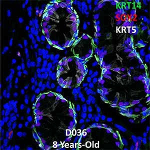 8 Year-Old Human Lung Confocal Imaging Donor D036 KRT14, SOX2, and KRT5