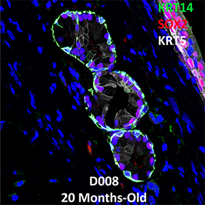 20 Month-Old Human Lung Confocal Imaging Donor D008 KRT14, SOX2, and KRT5