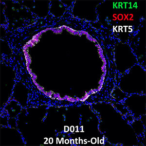 20 Month-Old Human Lung Confocal Imaging Donor D011 KRT14, SOX2, and KRT5