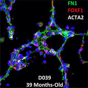 39 Month-Old Human Lung Confocal Imaging Donor D039 FN1, FOXF1, and ACTA2