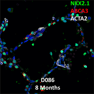 13 Month-Old Human Lung Confocal Imaging BPD Donor D083 Showing Expressions of NKX2.1, ABCA3, and ACTA2
