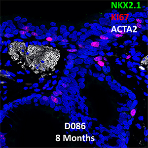 8 Month-old Human Lung Confocal Imaging BPD Donor D086 showing expressions of NKX2.1, KI67, and ACTA2