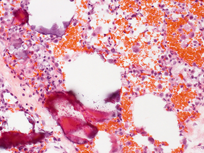 Human Lung Primary Alveolar Microlithiasis H&E Donor MC17.5H.A3.12