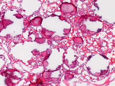 Human Lung Primary Alveolar Microlithiasis H&E Donor MC17.5H.B1.12