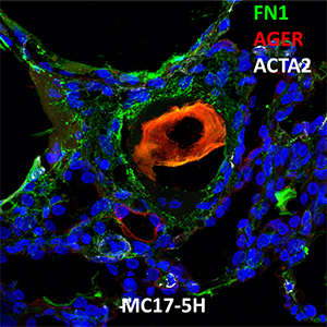 Human Lung Confocal Imaging MC17.5H.B1.11 Primary Alveolar Microlithiasis showing expressions of FN1, AGER and ACTA2