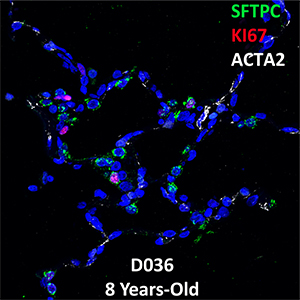 8 Year-Old Human Lung Confocal Imaging Donor D036 SFTPC, KI67, and ACTA2