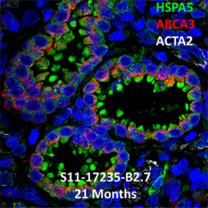 Human Lung Confocal Imaging S11-17235 Primary Alveolar Microlithiasis showing expressions of HSPA5, ABCA3, and ACTA2